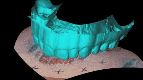 photo of bite mark analysis using forensic dentistry