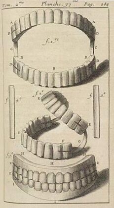 a rendering of Pierre Fauchard's dental prosthetic design.