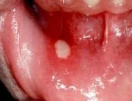 canker sore oral cancer