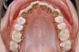 lingual braces are cemented to the back side of the teeth for a more aesthetic appearance