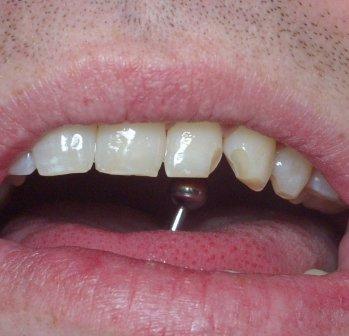 chipped and broken teeth are  common hazards of tongue piercings