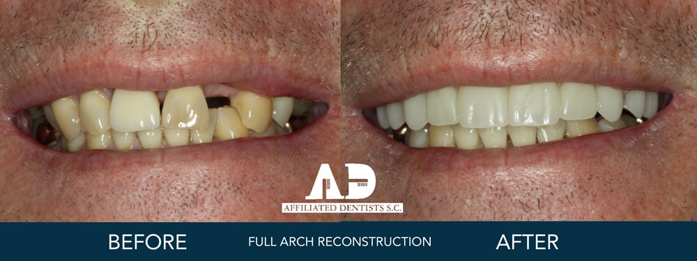 full arch before and after- Cosmetic Family Dentistry Madison