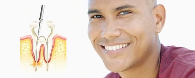 Root Canal graphic next to smiling man