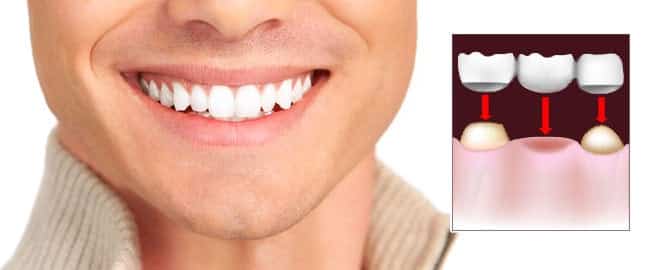 Smiling teeth with image of dental bridge