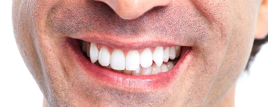 Teeth after full arch Reconstruction