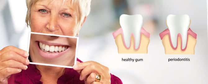 Periodontal Maintenance - Woman holding image of heatlhy smile next to healthy gum versus periodontits